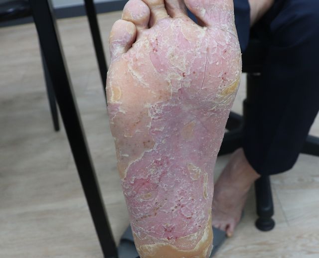 건선 치료 전