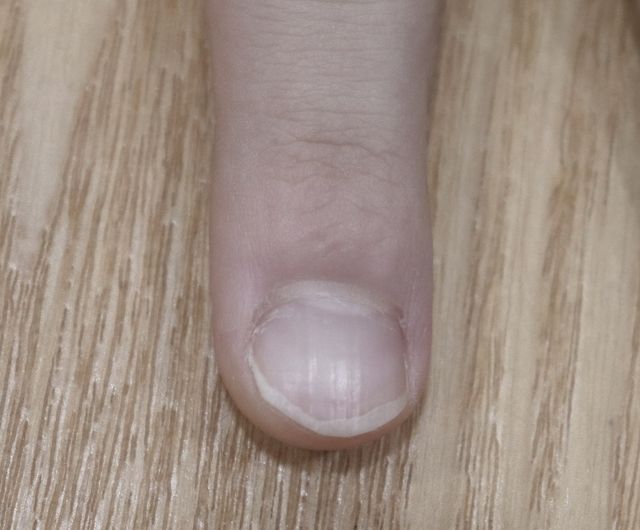13세 남성 · 6개월 경과