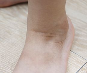 4세 여 · 5개월 경과