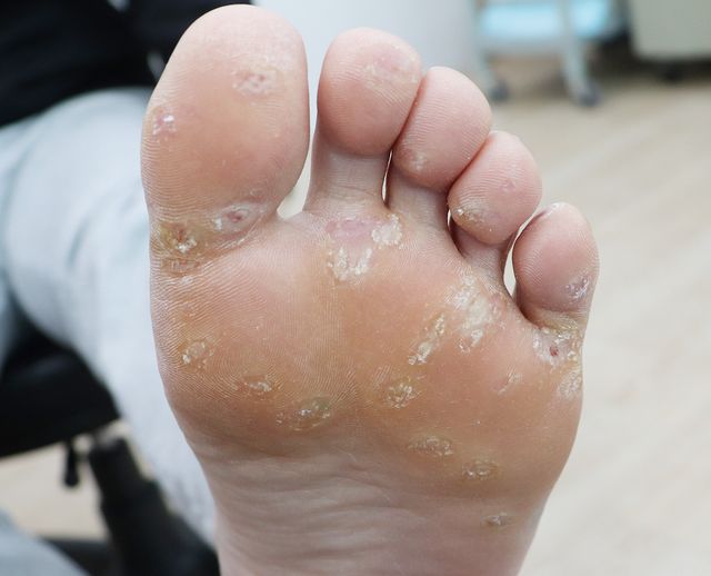 사마귀 치료 전