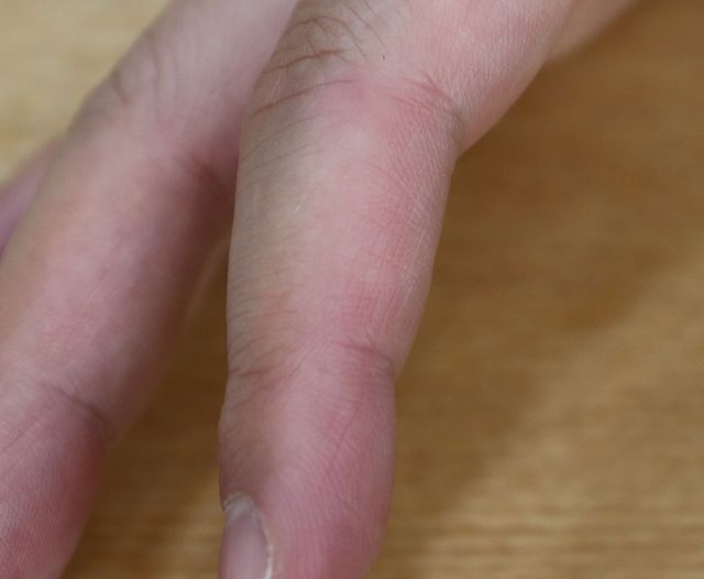 35세 남성 · 6개월 경과