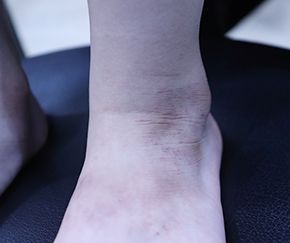 아토피 치료 전
