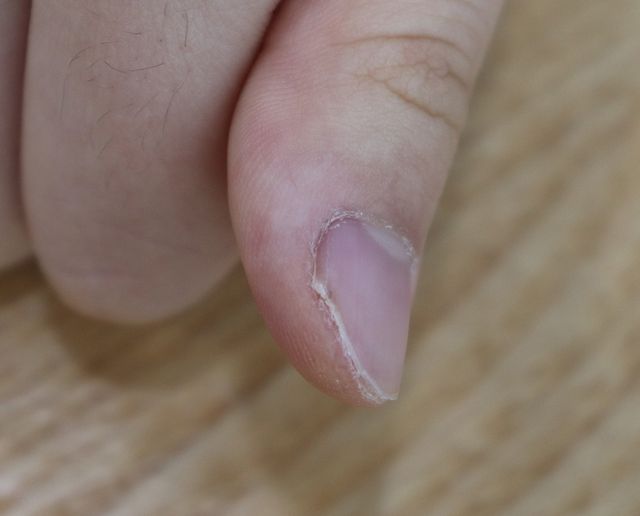 14세 여성 · 7개월 경과
