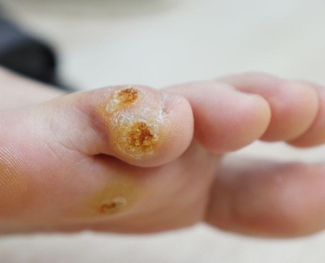 사마귀 치료 전